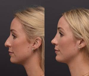 Rhinoplasty Without Breaking Bones?