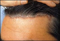 Is the Scalp Flap Procedure Really Safe?