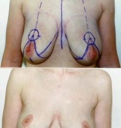 The Evolving Breast-Reduction Procedure