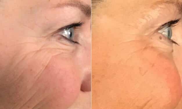 Cynosure, LaserAway Advance RF Microneedling Technology