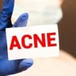 How to Tell Which Type of Acne You Have, So You Can Effectively Treat It