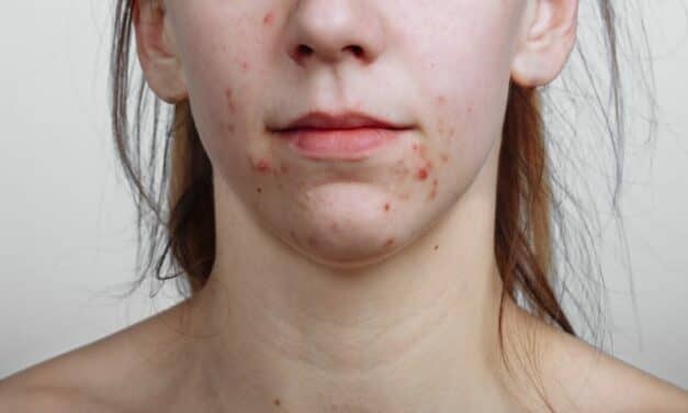 Acne Can Take Big Emotional Toll on Women
