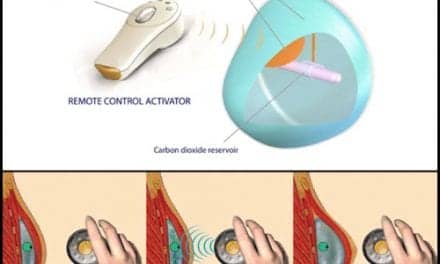 Aeroform Expansion Device May Be a Game Changer for Breast Cancer Patients Seeking Reconstruction