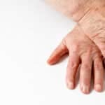 Two Topical Treatments for Hands Show Similar Improvement in Age Spots