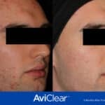 Arizona Med Spa to Offer AviClear Acne Laser Treatment