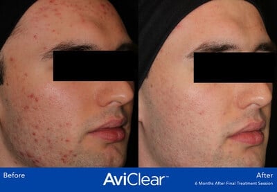 Arizona Med Spa to Offer AviClear Acne Laser Treatment