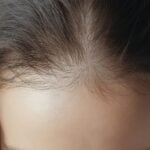 Bempikibart Shows Sustained Hair Regrowth in Alopecia Areata