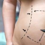 Bariatric Surgery Patients Regain More Weight After Body Contouring