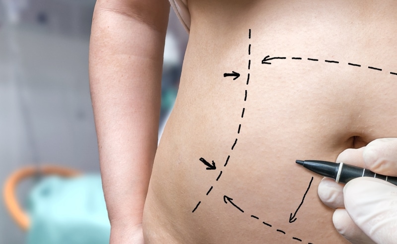 Bariatric Surgery Patients Regain More Weight After Body Contouring