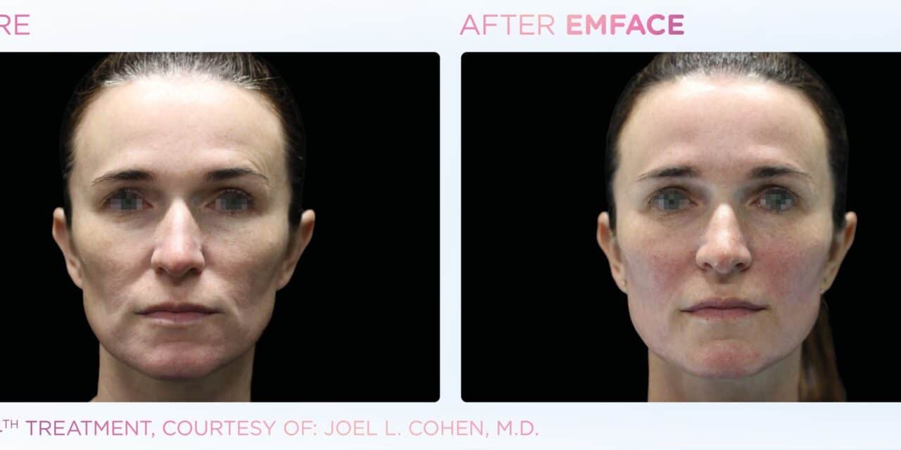 Non-Invasive Facial Lifting Procedure Emface Surpasses 1 Million Treatments 