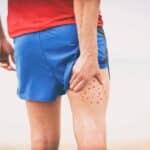 How to Get Rid of Butt Acne, According to Dermatologists
