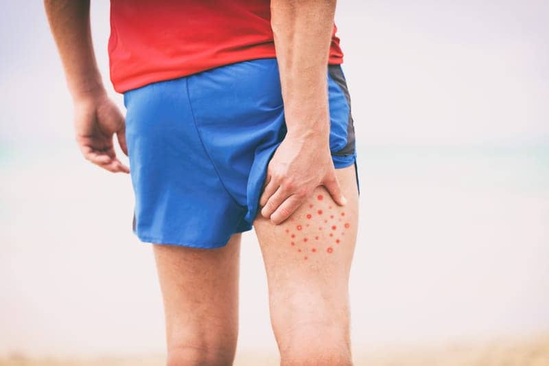 How to Get Rid of Butt Acne, According to Dermatologists