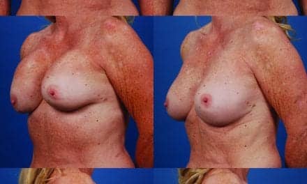 The Breast: Closing In on Capsular Contracture