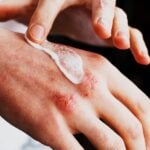 Investigational Cream Improves Chronic Hand Eczema Symptoms