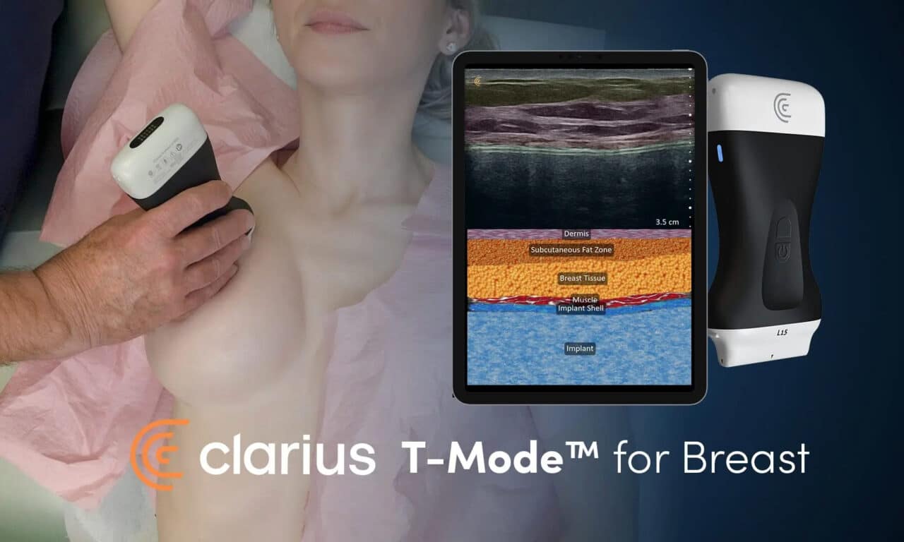 Clarius Launches AI-Powered T-Mode for Breast Ultrasound Training