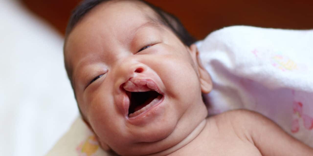 Racial and Ethnic Disparities in Cleft Lip Surgery for Children
