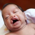 Racial and Ethnic Disparities in Cleft Lip Surgery for Children