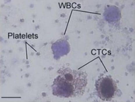 Sensitive, Noninvasive Platform Detects Circulating Tumor Cells in Melanoma Patients