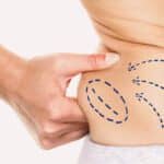 EON Laser Technology Offers Non-Invasive Fat Reduction