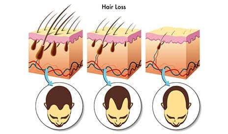 Hair Loss and Balding: Hidden Viruses Could Be the Culprit