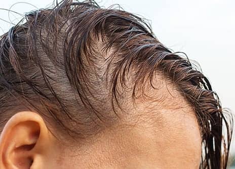 Platelet-Rich Plasma Could Be Effective For Hair Loss
