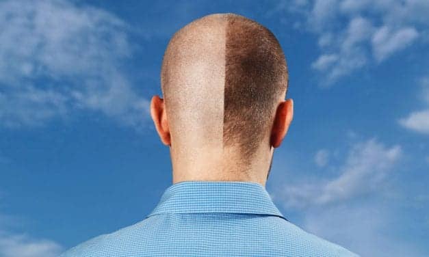 Every 13th Man Has a Hair Transplant According to Bookimed Study