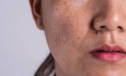 Derm-Approved Ways to Get Rid of Dark Spots on Every Skin Tone