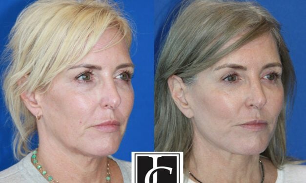 The Natural Lift Facelift Highlighted at Industry Events
