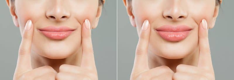 Influencing the Industry: How to Decide if You Need a Lip Flip or Lip Filler