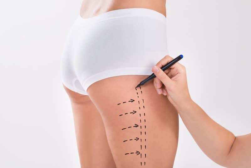 FDA Clears Renuvion for Post-Liposuction Soft-Tissue Coagulation