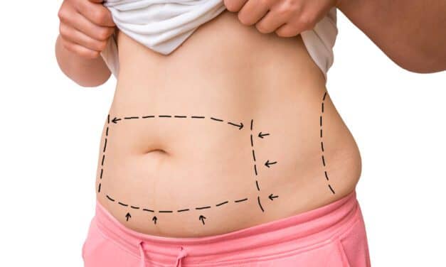 What Patients Should Know Before a Mommy Makeover