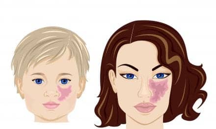 Non-Invasive Imaging Used to Help Evaluate Laser-Resistant Port Wine Stains
