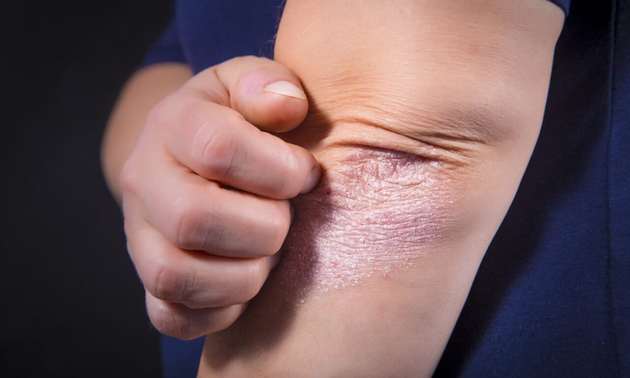 TYK2 Inhibitor Shows Promise for Moderate-to-Severe Psoriasis