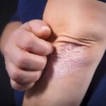 TYK2 Inhibitor Shows Promise for Moderate-to-Severe Psoriasis