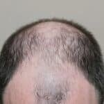 Dr J. Epstein Launches Hair Restoration Method Through Inspire Aesthetics Group