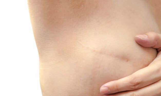 Industry Celebrates Breast Reconstruction Awareness Day USA