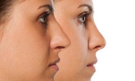 The Beauty Industry’s Most Entrenched Diversity Problem is Ethnic Plastic Surgery