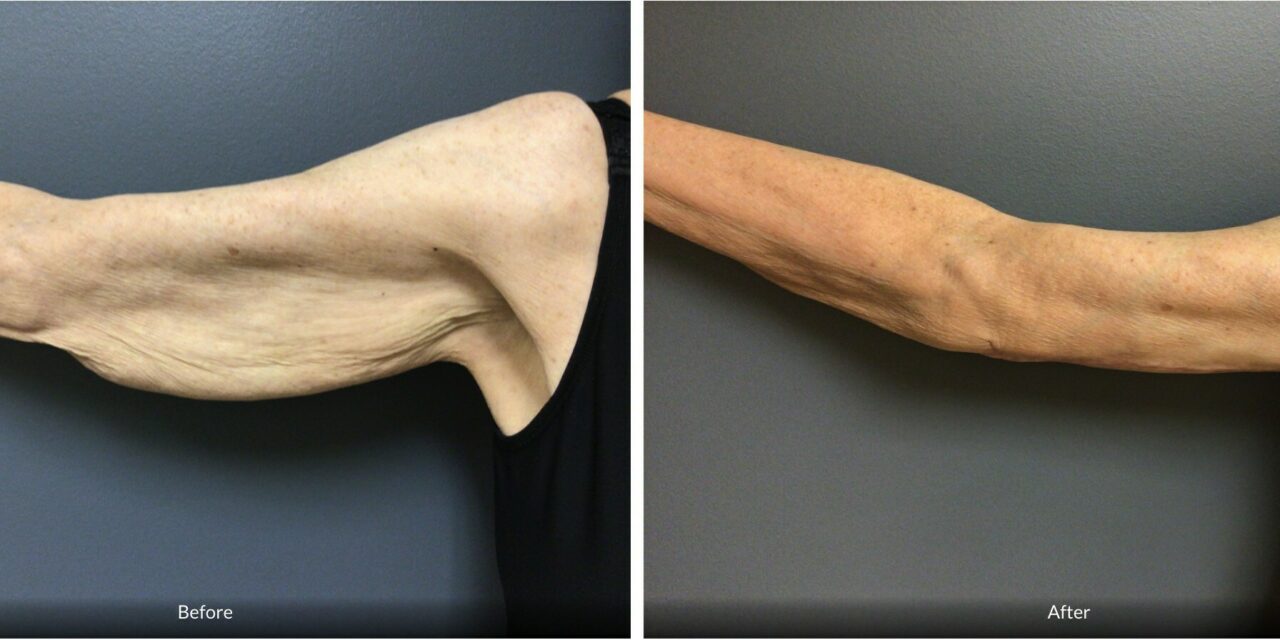 Aesthetic Center Sees Surge in Arm Lifts After Weight Loss