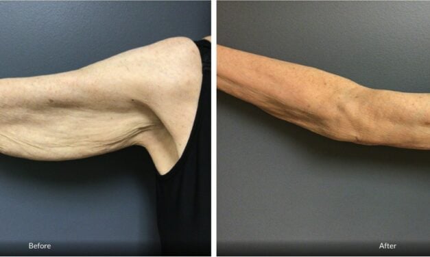 Aesthetic Center Sees Surge in Arm Lifts After Weight Loss