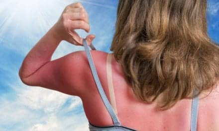 Itchy Sunburn? Here’s How To Relieve Hell’s Itch, According To Experts