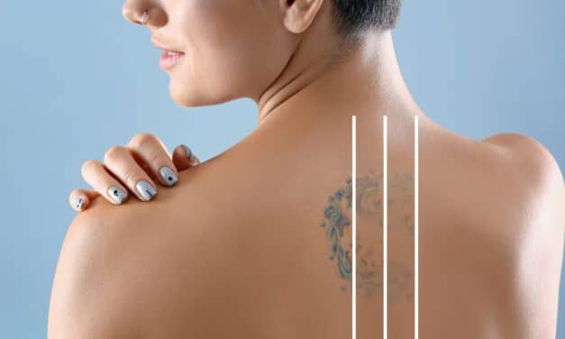 National  Tattoo Removal Day is August 14
