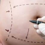 Evolution of Abdominoplasty Techniques: A 16-Year Analysis