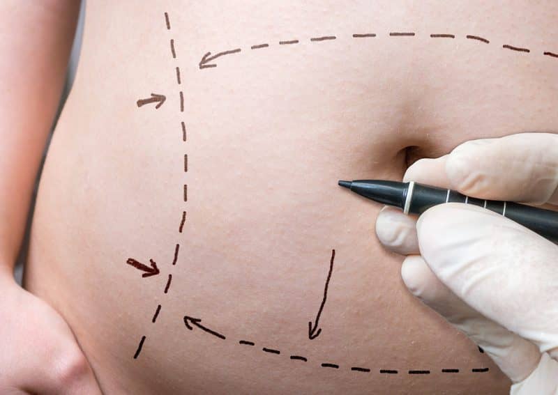 Evolution of Abdominoplasty Techniques: A 16-Year Analysis