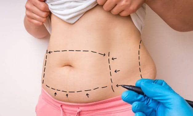 Plastic Surgeon Releases Tummy Tuck Guide