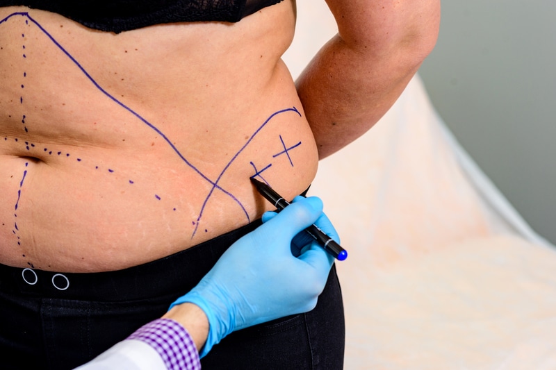 How UCHD Liposuction Is Redefining Body Contouring