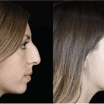 Nerve Block Innovation: Reducing Pain in Rhinoplasty