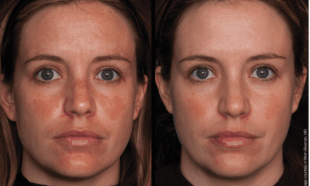 Unlocking Practice Growth: A Case Study on the Marini Peel System