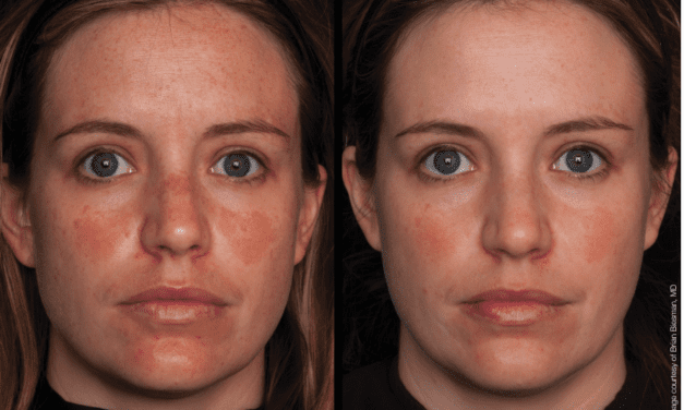 Unlocking Practice Growth: A Case Study on the Marini Peel System
