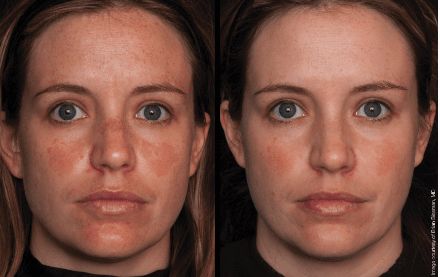 Unlocking Practice Growth: A Case Study on the Marini Peel System